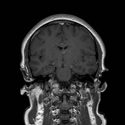 File:Neuro-Behcet's disease (Radiopaedia 21557-21505 Coronal T1 C+ 10).jpg
