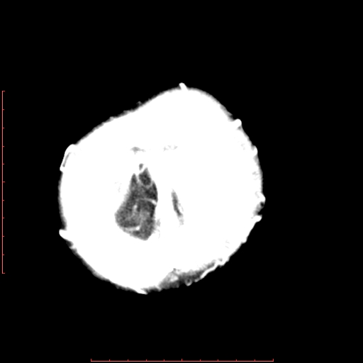File:Neuroblastoma skull metastasis (Radiopaedia 56053-62683 Axial +Contrast 16).jpg