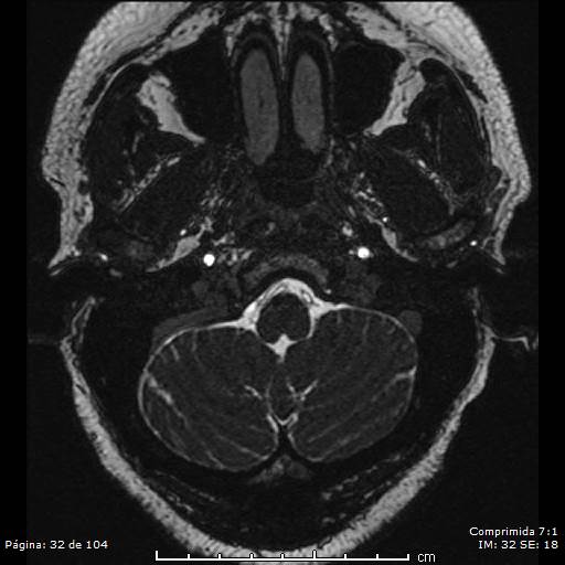 Neurocysticercosis (Radiopaedia 58636-65832 I 32).jpg