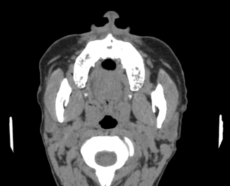 Neurofibromatosis type 1- orbital manifestations (Radiopaedia 49391-54511 Axial non-contrast 9).jpg