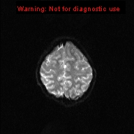 File:Neurofibromatosis type 1 with optic nerve glioma (Radiopaedia 16288-15965 Axial DWI 4).jpg