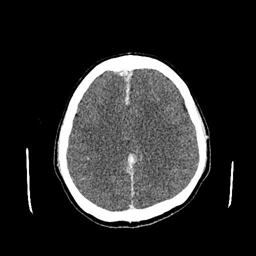 File:Neurofibromatosis type 2 (Radiopaedia 25389-25637 Axial C+ 64).jpg