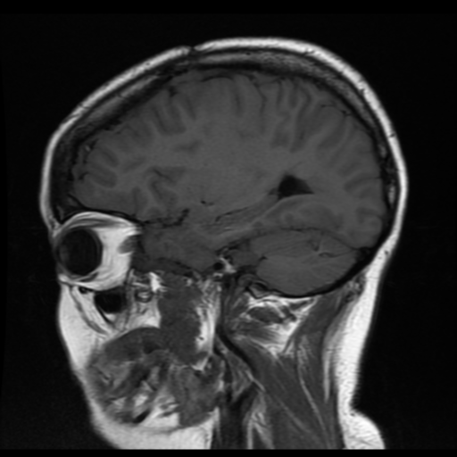 File:Neurofibromatosis type 2 (Radiopaedia 45229-49251 Sagittal T1 6).png
