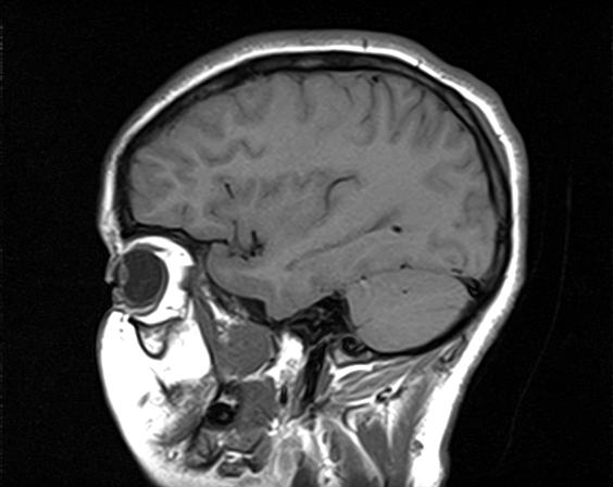 File:Neurofibromatosis type 2 (Radiopaedia 66211-75401 Sagittal T1 19).jpg