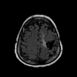File:Neurofibromatosis type 2 (Radiopaedia 8713-9518 Axial FLAIR 5).jpg