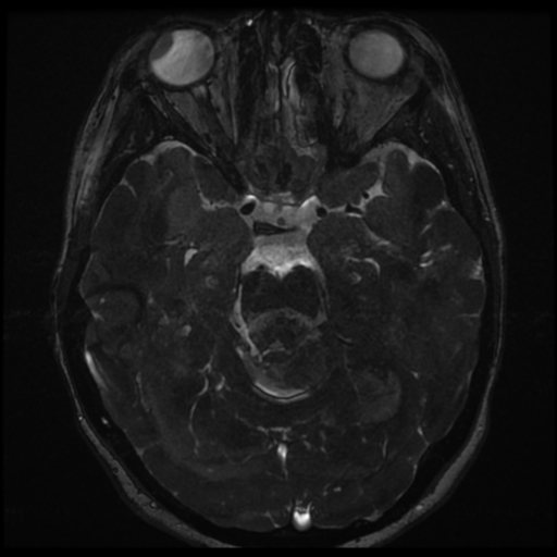 Neurofibromatosis type 2 - bilateral acoustic neuromata (Radiopaedia 40060-42566 Axial FIESTA 78).png