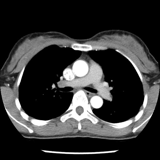 File:Non-small cell lung cancer with miliary metastases (Radiopaedia 23995-24193 A 19).jpg