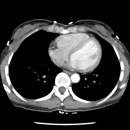 File:Non-small cell lung cancer with miliary metastases (Radiopaedia 23995-24193 A 28).jpg