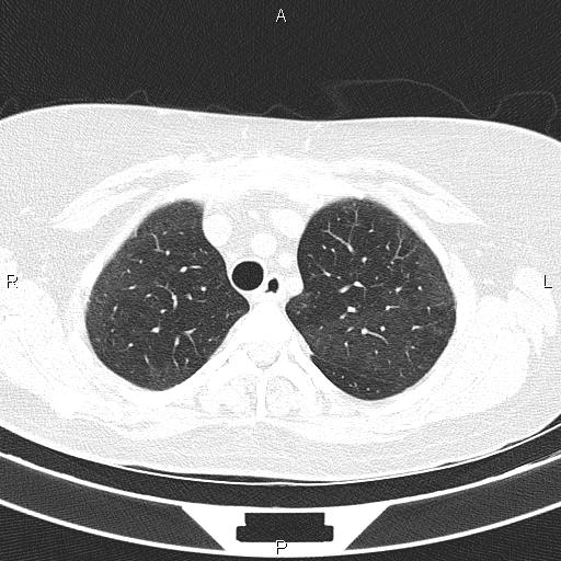 Non-specific interstitial pneumonia (Radiopaedia 83185-97567 Axial lung window 18).jpg