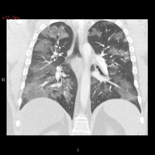 File:Non-specific interstitial pneumonitis (Radiopaedia 27044-27222 Coronal lung window 34).jpg