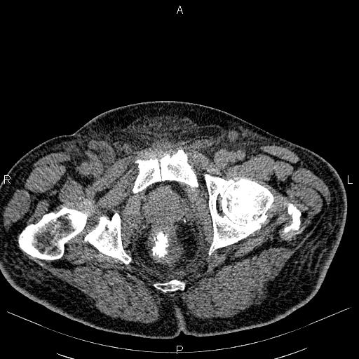 File:Non Hodgkin lymphoma in a patient with ankylosing spondylitis (Radiopaedia 84323-99621 Axial non-contrast 61).jpg