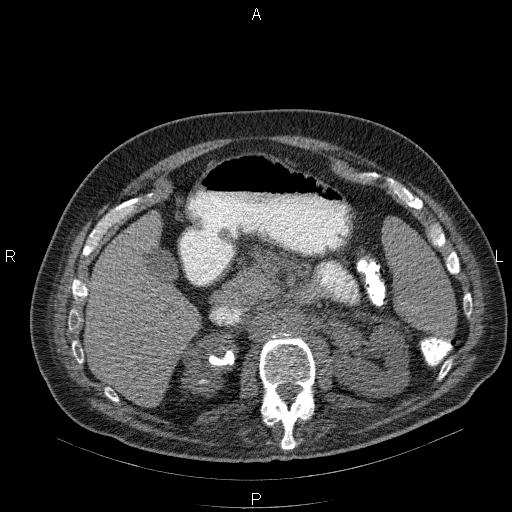 File:Non Hodgkin lymphoma in a patient with ankylosing spondylitis (Radiopaedia 84323-99624 Axial non-contrast 38).jpg