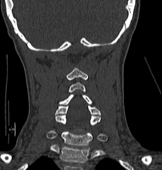 File:Normal CT cervical spine - 12-year-old (Radiopaedia 55352-61775 Coronal bone window 145).jpg