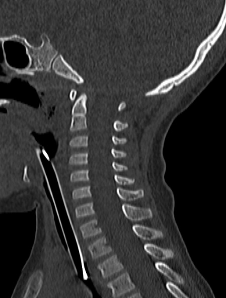 Normal CT cervical spine - pediatric (Radiopaedia 52549-58462 Sagittal bone window 99).jpg