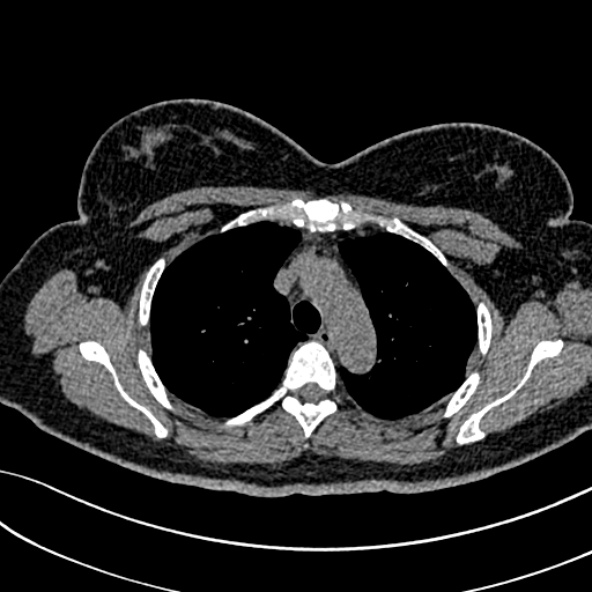Normal CT chest- adult female (Radiopaedia 52522-58428 Axial non-contrast 39).jpg