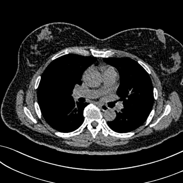 Normal CT chest- adult female (Radiopaedia 52522-58428 Axial non-contrast 63).jpg