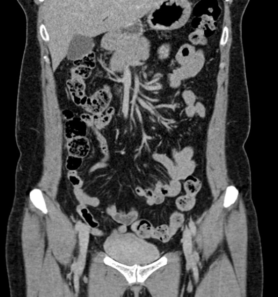 Normal CT intravenous urogram (Radiopaedia 39444-41759 A 222).jpg