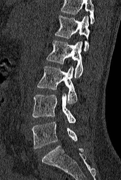 File:Normal CT lumbar spine (Radiopaedia 53981-60118 Sagittal bone window 40).jpg