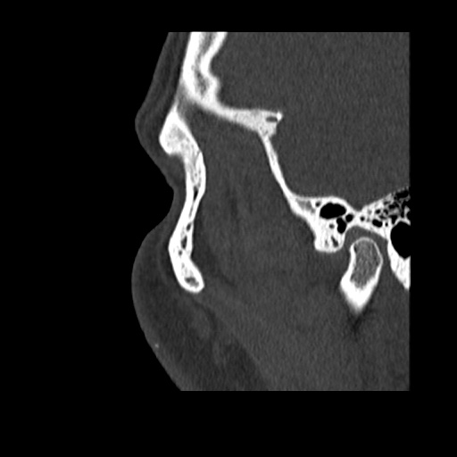 Normal CT paranasal sinuses (Radiopaedia 42286-45390 Sagittal bone window 2).jpg