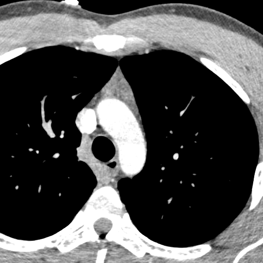 File:Normal CT pulmonary veins (pre RF ablation) (Radiopaedia 41748-44702 A 1).png