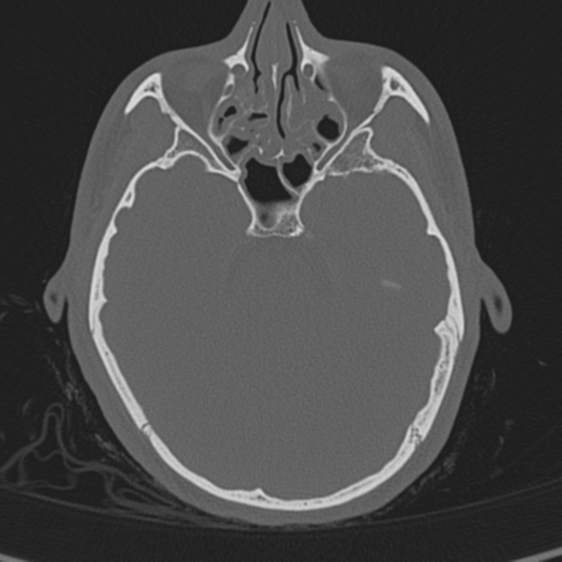 Normal CT skull (Radiopaedia 40798-43459 A 52).png