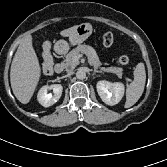 File:Normal CT split bolus study of the renal tract (Radiopaedia 48631-53634 Axial split bolus 50).jpg