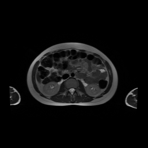 File:Normal MRI abdomen in pregnancy (Radiopaedia 88001-104541 Axial T2 29).jpg
