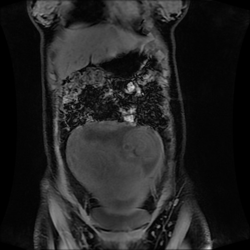 Normal MRI abdomen in pregnancy (Radiopaedia 88001-104541 M 41).jpg