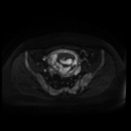 Normal MRI abdomen in pregnancy (Radiopaedia 88005-104548 Axial DWI 94).jpg