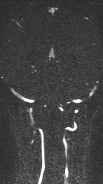 Normal MRI brain with MRV- teenager (Radiopaedia 49425-54553 Coronal MRV 161).jpg