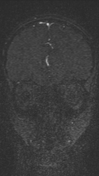 Normal MRI brain with MRV- teenager (Radiopaedia 49425-54553 Coronal MRV 76).jpg