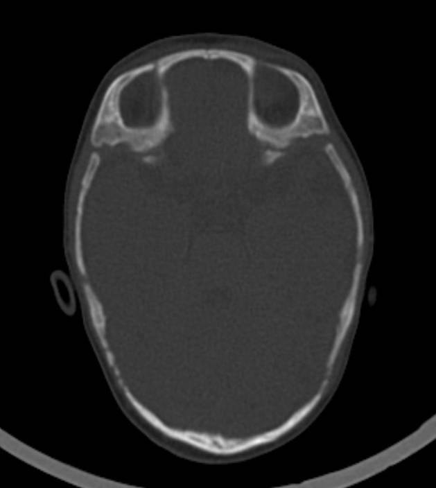 Normal brain CT - 2-month-old (Radiopaedia 53369-59350 Axial bone window 41).jpg