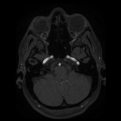 Normal brain MRA (Radiopaedia 41046-43793 Axial MRA 94).png