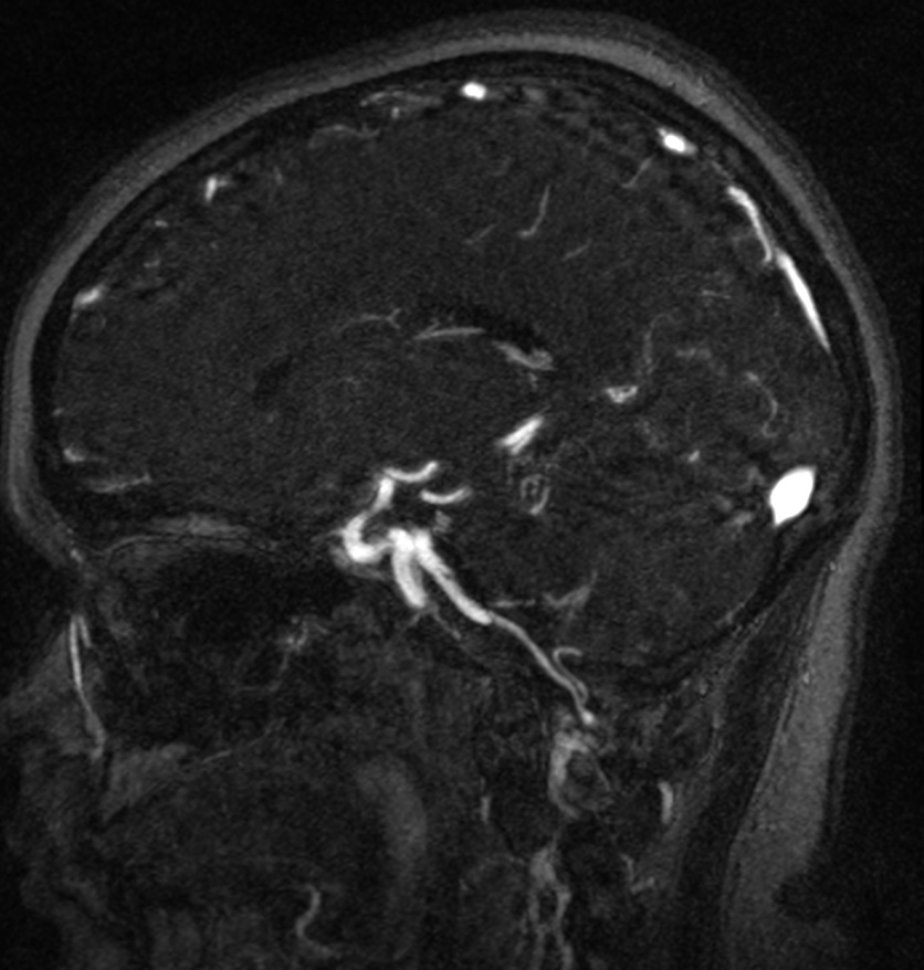 Normal brain MRI and venogram (Radiopaedia 39554-41862 Sagittal MRV 39).jpg