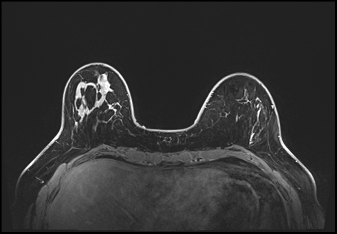 Normal breast MRI - dense breasts (Radiopaedia 80454-93850 C 56).jpg