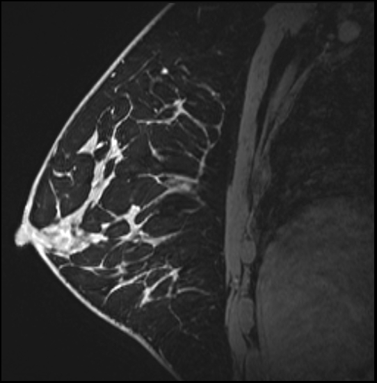 Normal breast MRI - dense breasts (Radiopaedia 80454-93850 I 118).jpg