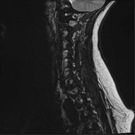 File:Normal cervical spine MRI (including Dixon) (Radiopaedia 42762-45925 Dixon- opposed phase 13).png