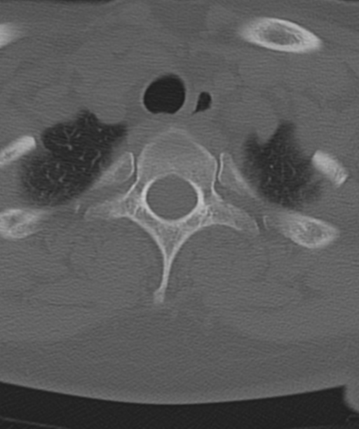 Normal cervical spine MRI (including Dixon) (Radiopaedia 42762-45926 Axial bone window 54).png