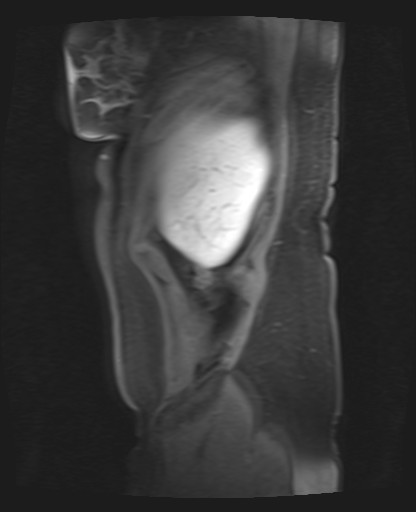 File:Normal hepatobiliary phase liver MRI (Radiopaedia 58968-66230 C 7).jpg