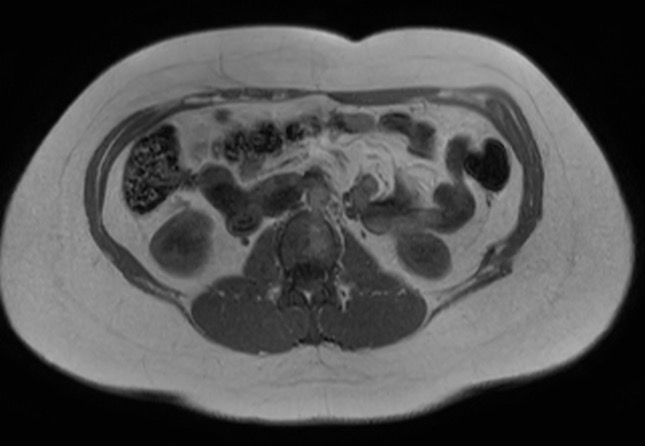 File:Normal liver MRI with Gadolinium (Radiopaedia 58913-66163 Axial T1 in-phase 8).jpg