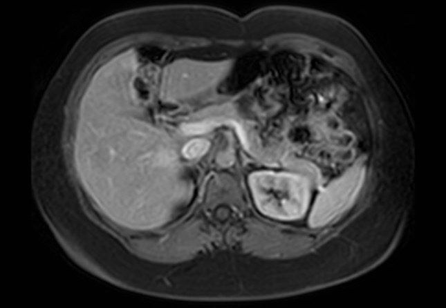 Normal liver MRI with Gadolinium (Radiopaedia 58913-66163 J 40).jpg