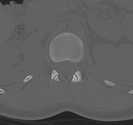 File:Normal lumbar spine CT (Radiopaedia 46533-50986 Axial bone window 7).png