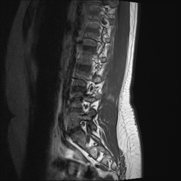 File:Normal lumbar spine MRI- 3 T (Radiopaedia 53280-59250 Sagittal T1 7).jpg