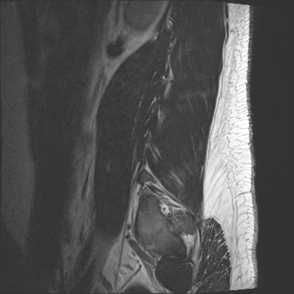 File:Normal lumbar spine MRI (Radiopaedia 47857-52609 Sagittal T2 21).jpg