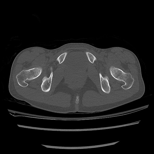 Normal pelvis CT (Radiopaedia 51471-57236 Axial bone window 82).jpg