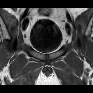 File:Normal prostate (MRI) (Radiopaedia 29986-30535 Coronal T1 1).jpg