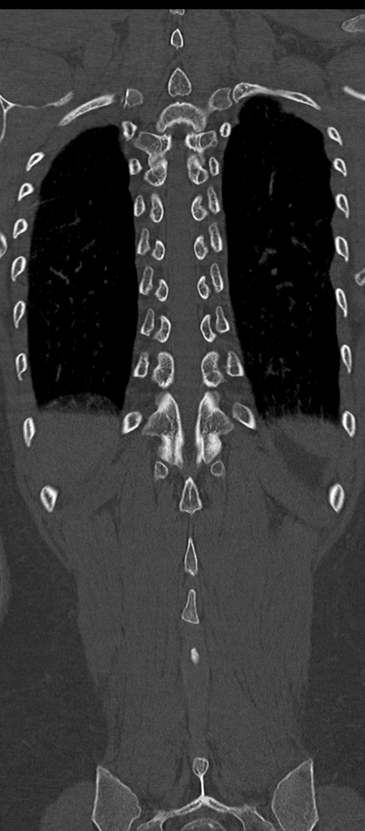 Normal thoracolumbar spine (Radiopaedia 43822-47309 Coronal bone window 72).png