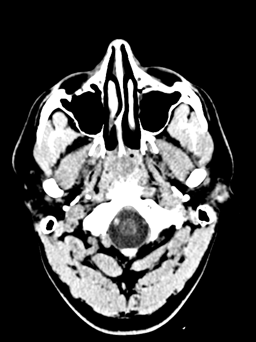 Normal trauma protocol brain and C-spine CT (Radiopaedia 83302-97709 Axial non-contrast 65).jpg