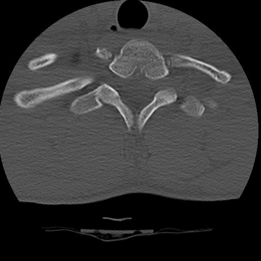 File:Normal trauma spine imaging (age 16) (Radiopaedia 45335-49358 Axial bone window 73).jpg