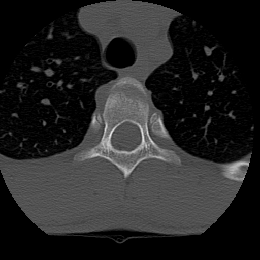 Normal trauma spine imaging (age 16) (Radiopaedia 45335-49358 Axial bone window 99).jpg
